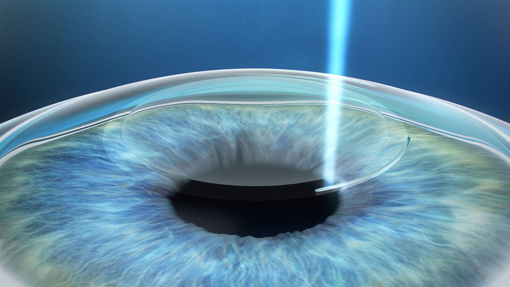Relex Smile Průběh laserové operace očí